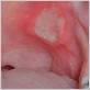 sore gums crohn's disease