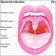 sore throat gum disease