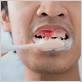 spitting blood gum disease