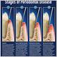 stages of periodontal gum disease