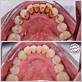 stain teeth removal