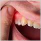 swollen gum disease treatment