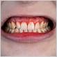 swollen gums lyme disease
