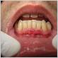 symptoms of gum disease mouth cancer