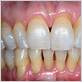 systwmic disease causes gum.recession and tooth demineralization causes acute