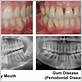 tampa gum disease