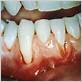 teeth bad sore after waterpik
