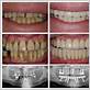 teeth gum disease cure
