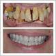 teeth implants gum disease