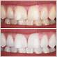 teeth whitening after gum disease treatment