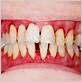 teeth with gum disease pictures