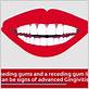 the gum disease gingivitis commercial