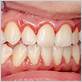 the gum disease known as gingivitis commercial