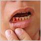 thyroid disease and bleeding gums