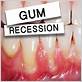 tighten loose teeth gum disease