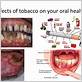 tobacco use and gum disease