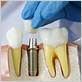 tools for dental implants