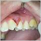 tooth abscess gum disease