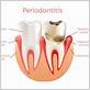 tooth extraction and gum disease