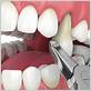 tooth extraction gum disease