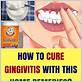 treat gingivitis at home