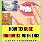 treating gingivitis at home