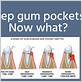 treatment for deep pockets in gums