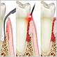 treatment for gum disease bluffton