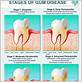 type of gum disease