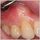 upper gum inflammation