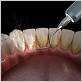 vacaville gum disease treatment