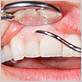 vallejo gum disease treatment