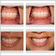 veneers on teeth with gum disease