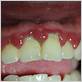 vincents disease gums