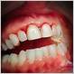 von willebrand disease bleeding gums
