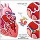 water flosser bacteremia infective endocarditis