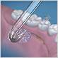 waterpik attachements for implants