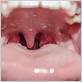 waterpik causes tonsils to bleed