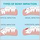 waterpik impacted wisdom teeth