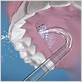 waterpik implant denture tip