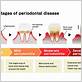 what are the causes of periodontal gum disease