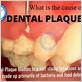 what causes pyria gum disease