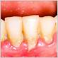 what causes receding gums when no disease is present