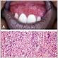 what causes strawberry gum disease