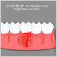 what does gum bleeding mean