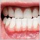 what does gums disease look like