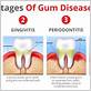 what gum disease causes