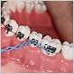 what is a dental power chain