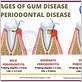 what is gum disease in hindi