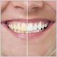 what is the most effective way to whiten teeth